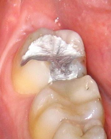 Amalgamfüllung direkt nach Herstellung