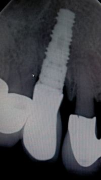 Röntgenbild Implantat