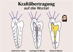 Wurzelstifte 1